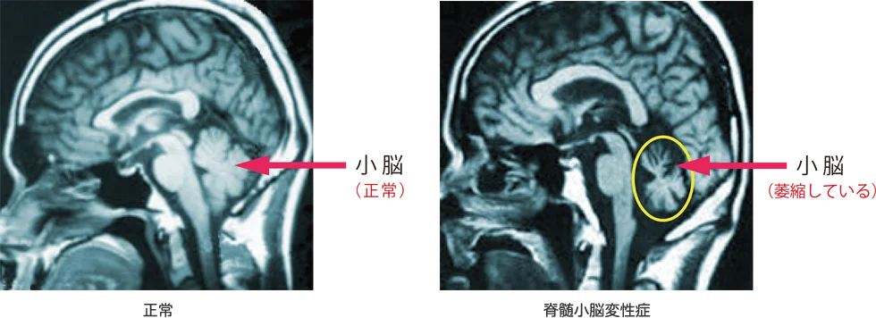 検査方法の画像（正常な小脳と萎縮した小脳のMRI比較）