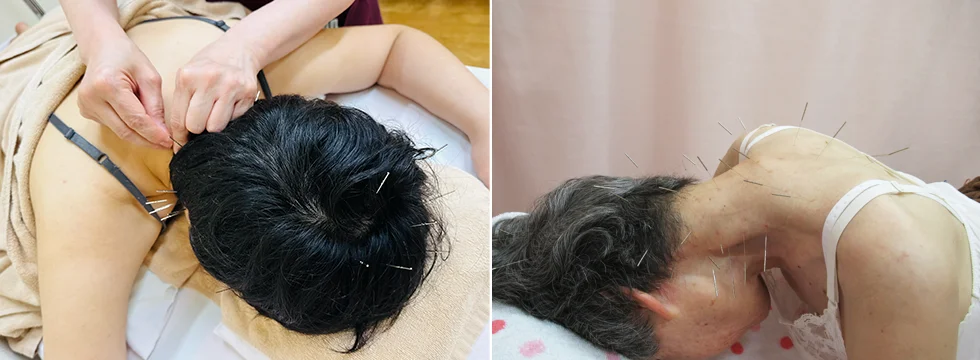 ジストニア鍼灸治療の画像