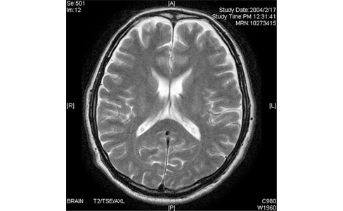 脳のレントゲンの画像